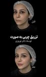 تزریق چربی